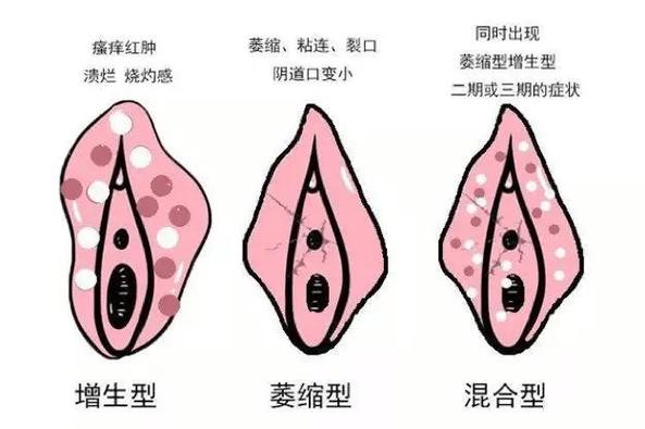 什么是妇科白斑_:什么是妇科白斑图片和症状